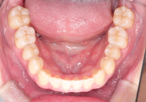 前歯のクロスバイトとガタつきをマウスピース矯正(インビザライン )で治療した症例の治療後
