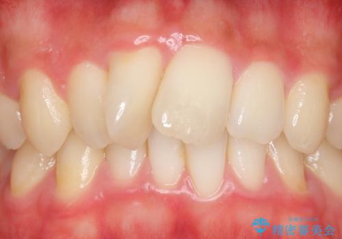 セラミック矯正　気になる前歯の歯並びの改善の治療前