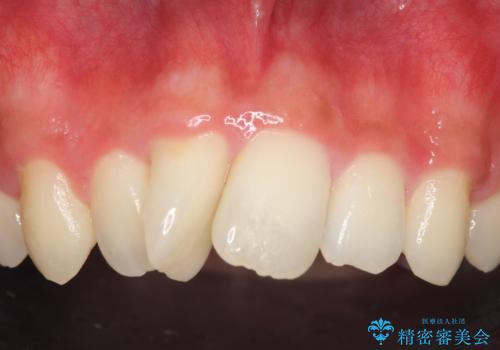 セラミック矯正 気になる前歯の歯並びの改善の治療前