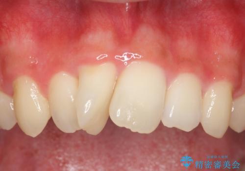 セラミック矯正　気になる前歯の歯並びの改善の症例 治療前