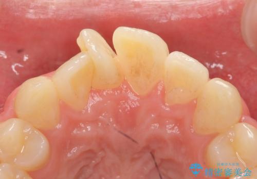 セラミック矯正 気になる前歯の歯並びの改善の治療前