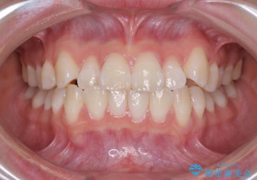 海外留学をしながら歯並びを整えたい インビザラインによる矯正治療の症例 治療前