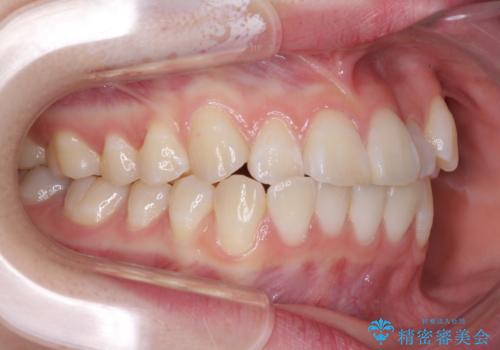 海外留学をしながら歯並びを整えたい インビザラインによる矯正治療の治療前