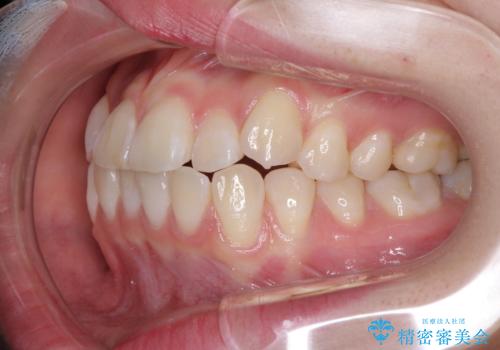 海外留学をしながら歯並びを整えたい インビザラインによる矯正治療の治療前
