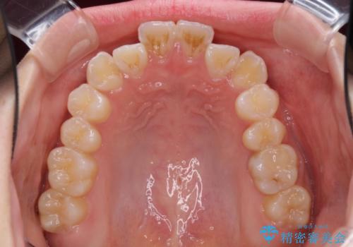 海外留学をしながら歯並びを整えたい インビザラインによる矯正治療の治療前