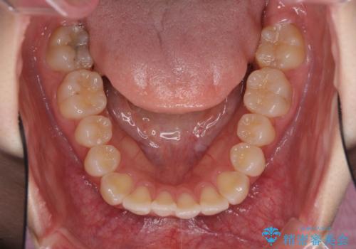 海外留学をしながら歯並びを整えたい インビザラインによる矯正治療の治療前