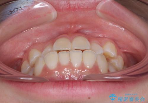海外留学をしながら歯並びを整えたい インビザラインによる矯正治療の治療前