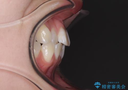 海外留学をしながら歯並びを整えたい インビザラインによる矯正治療の治療前