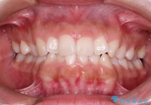 インビザラインを用いた叢生(歯並びのガタつき)の治療