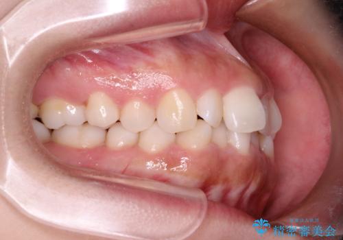 インビザラインを用いた叢生(歯並びのガタつき)の治療の治療前