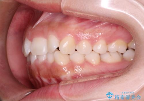 インビザラインを用いた叢生(歯並びのガタつき)の治療の治療前