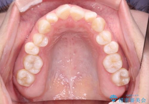 インビザラインを用いた叢生(歯並びのガタつき)の治療の治療前