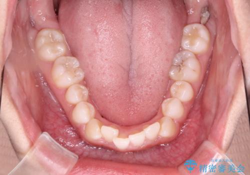 インビザラインを用いた叢生(歯並びのガタつき)の治療の治療前