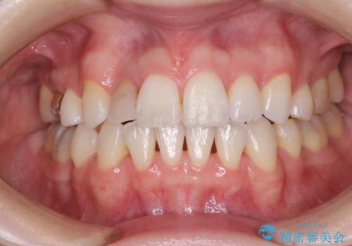 変色した前歯　オーダーメイドタイプのオールセラミッククラウンの治療前