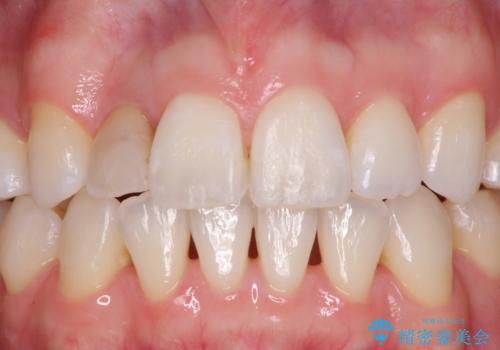 変色した前歯 オーダーメイドタイプのオールセラミッククラウンの治療前