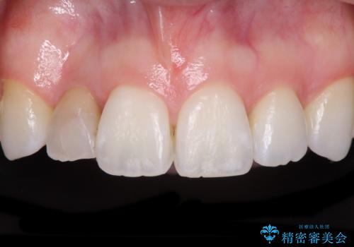 変色した前歯 オーダーメイドタイプのオールセラミッククラウンの症例 治療前