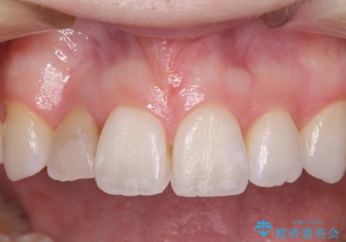 変色した前歯 オーダーメイドタイプのオールセラミッククラウンの治療前