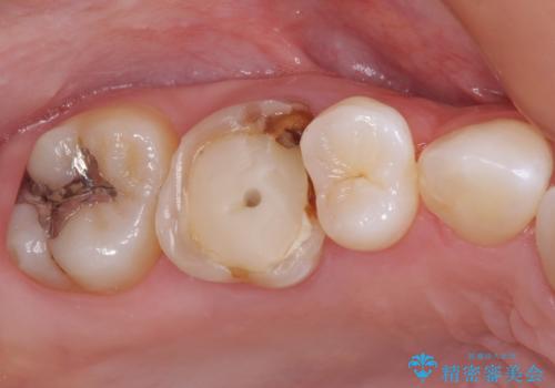 変色した前歯 オーダーメイドタイプのオールセラミッククラウンの治療前