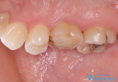 変色した前歯 オーダーメイドタイプのオールセラミッククラウンの治療前