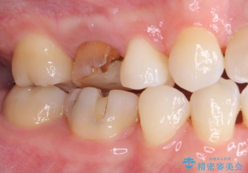 変色した前歯 オーダーメイドタイプのオールセラミッククラウンの治療前