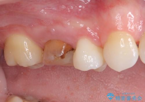 変色した前歯 オーダーメイドタイプのオールセラミッククラウンの治療前