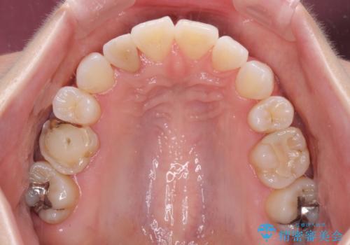 変色した前歯 オーダーメイドタイプのオールセラミッククラウンの治療前