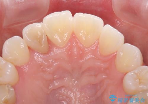 変色した前歯 オーダーメイドタイプのオールセラミッククラウンの治療前