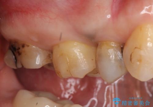 オールセラミッククラウン しみる歯の治療の治療前