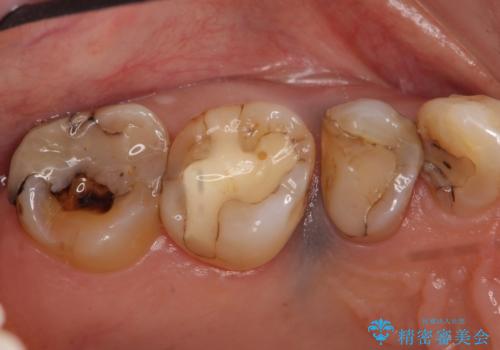 オールセラミッククラウン しみる歯の治療の治療前