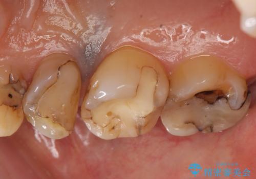 オールセラミッククラウン しみる歯の治療の治療前