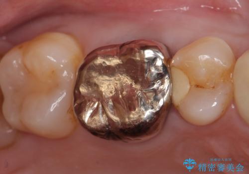 オールセラミッククラウン 他院にて治療困難と言われた歯の治療の症例 治療前