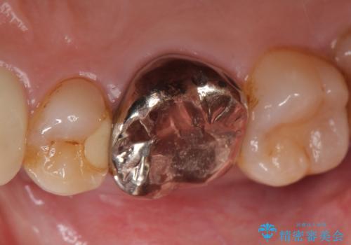 オールセラミッククラウン 他院にて治療困難と言われた歯の治療の治療前