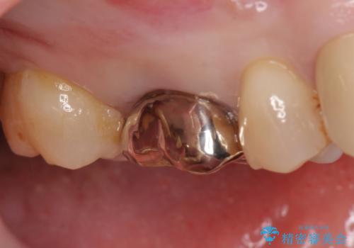 オールセラミッククラウン 他院にて治療困難と言われた歯の治療の治療前