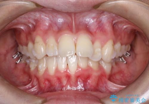 前歯の突出、深い噛み合わせ、ガタつきをマウスピース矯正(インビザライン)で治療した症例の治療中