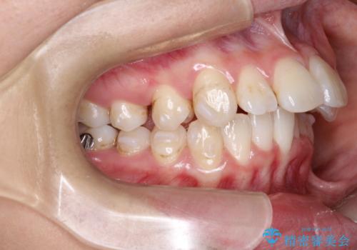 前歯の突出、深い噛み合わせ、ガタつきをマウスピース矯正(インビザライン)で治療した症例の治療中
