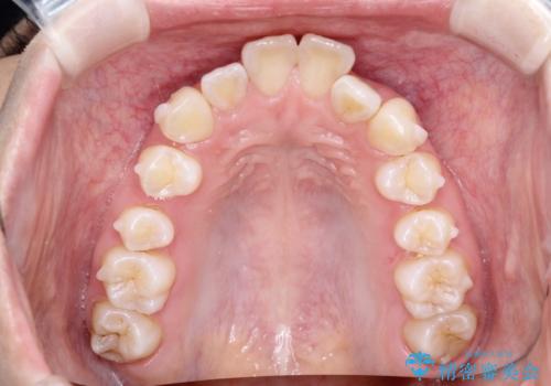 前歯の突出、深い噛み合わせ、ガタつきをマウスピース矯正(インビザライン)で治療した症例の治療中