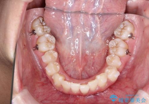 前歯の突出、深い噛み合わせ、ガタつきをマウスピース矯正(インビザライン)で治療した症例の治療中