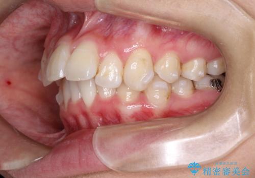 前歯の突出、深い噛み合わせ、ガタつきをマウスピース矯正(インビザライン)で治療した症例の治療中