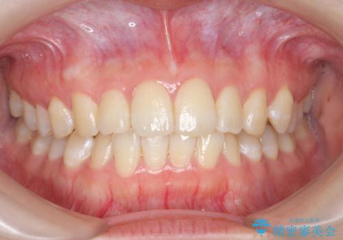 オフィスホワイトニングで、ご自身の歯を白く!の治療前