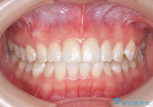 オフィスホワイトニングで、ご自身の歯を白く!の治療後