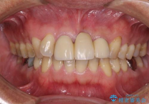 不自然な前歯のブリッジをオールセラミックできれいにの治療前