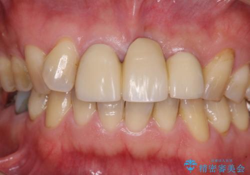 不自然な前歯のブリッジをオールセラミックできれいにの治療前