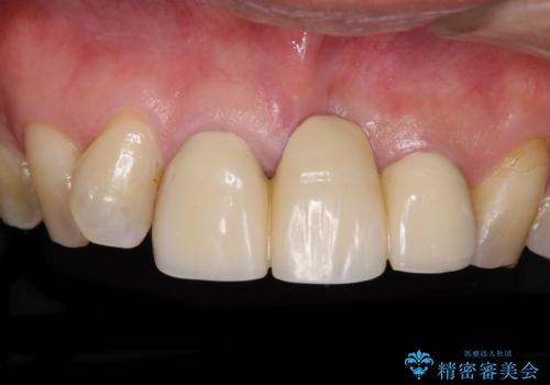 不自然な前歯のブリッジをオールセラミックできれいにの症例 治療前