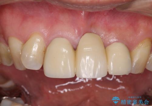 不自然な前歯のブリッジをオールセラミックできれいにの治療前