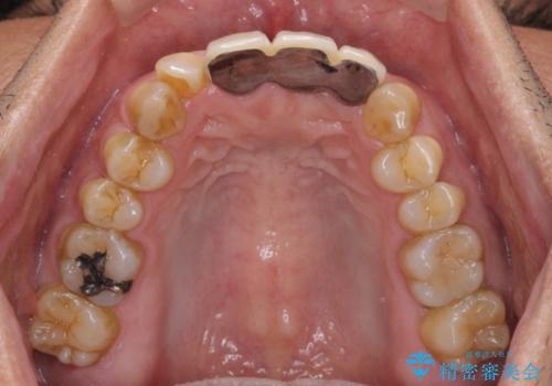 不自然な前歯のブリッジをオールセラミックできれいにの治療前