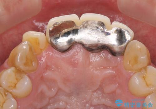 不自然な前歯のブリッジをオールセラミックできれいにの治療前