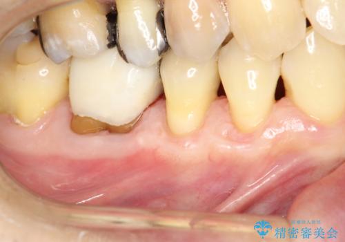 徐々に下がってきた歯肉へ再生療法(歯冠側移動術と結合組織移植術の併用)を施術し、丈夫な歯肉を獲得させた症例の症例 治療後
