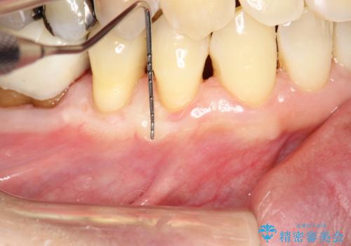 徐々に下がってきた歯肉へ再生療法(歯冠側移動術と結合組織移植術の併用)を施術し、丈夫な歯肉を獲得させた症例の治療後