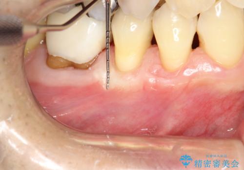 徐々に下がってきた歯肉へ再生療法(歯冠側移動術と結合組織移植術の併用)を施術し、丈夫な歯肉を獲得させた症例の治療後