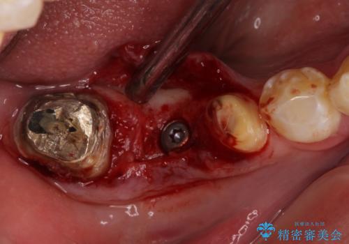 折れてしまった奥歯 インプラントによる補綴治療の治療中